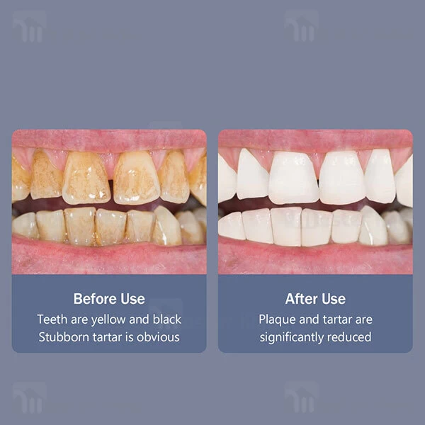 جرم گیر دندان Xiaomi Sunuo T11 Pro Ultrasonic Dental Scaler